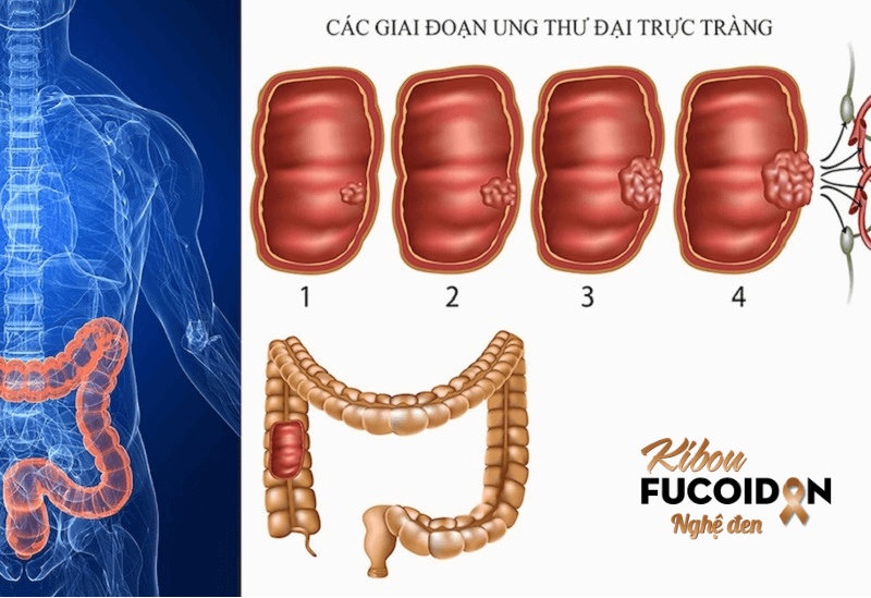 Ung thư đại tràng chia thành 4 giai đoạn với các phương pháp điều trị phù hợp