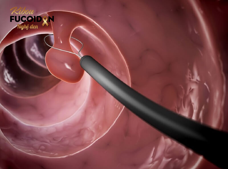 Điểm danh 9 nguyên nhân ung thư đại trực tràng Những người mắc polyp đại tràng thường có nguy cơ cao mắc ung thư đại trực tràng