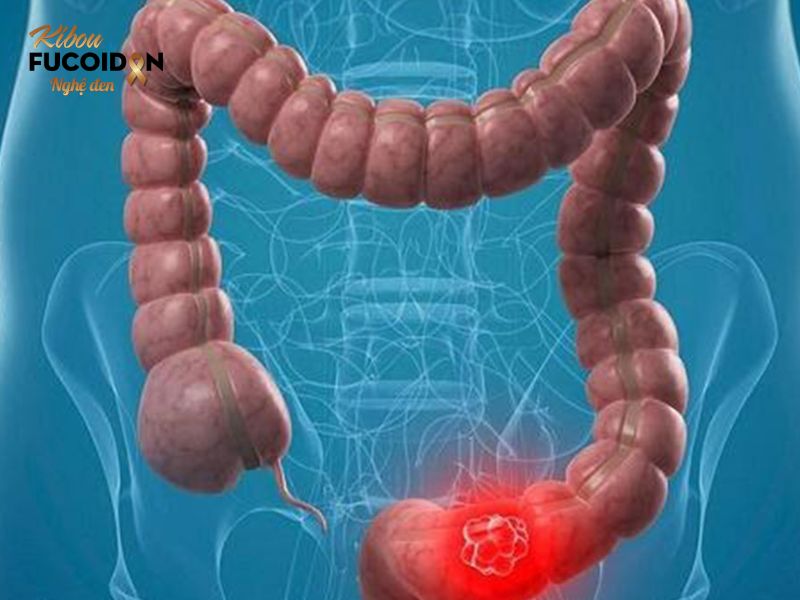 Triệu chứng và cách điều trị ung thư đại tràng giai đoạn 2 Ung thư đại tràng giai đoạn 2