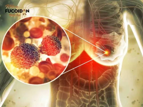 Phẫu thuật là lựa chọn phổ biến cho đa số bệnh nhân ung thư vú giai đoạn 1.
