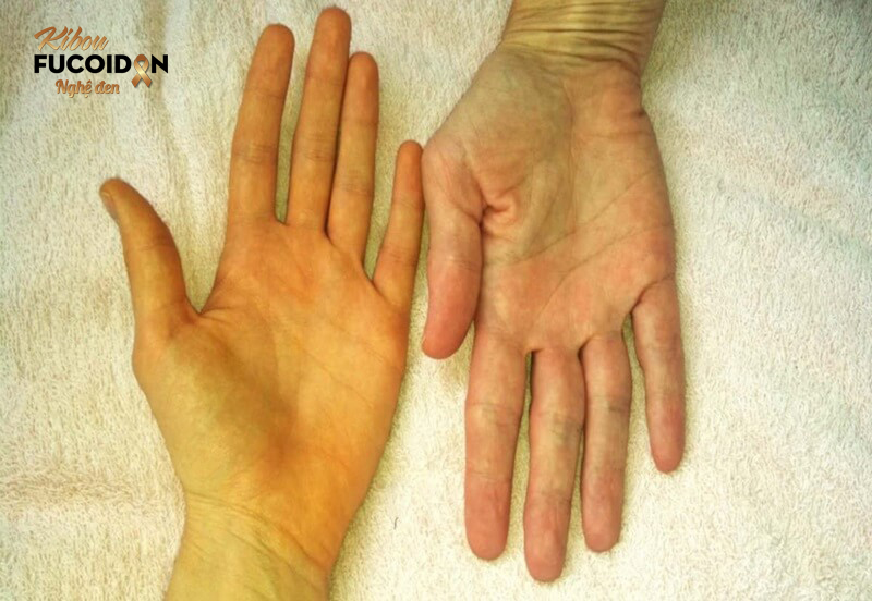 Những triệu chứng ung thư đại trực tràng không thể bỏ qua Khi ung thư di căn lên gan thì bệnh nhân có triệu chứng vàng da, vàng mắt, mẩn ngứa,...