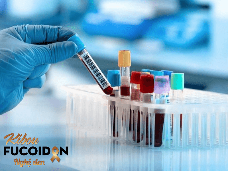 Những điều cần biết về tầm soát ung thư đại tràng Xét nghiệm máu giúp phát hiện sớm ung thư đại tràng