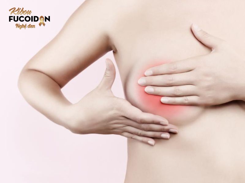 Ung thư vú dạng viêm: Dấu hiệu, cách điều trị và tiên lượng sống Bệnh ung thư vú dạng viêm
