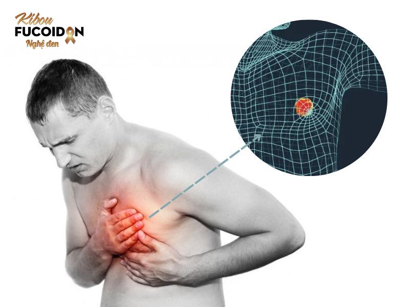 Ung thu vú ở đàn ông có nguy hiểm không? Dấu hiệu và cách điều trị Ung thư vú có thể xảy ra ở nam giới