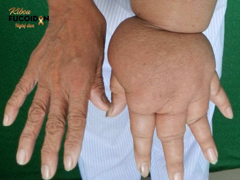 Cẩm nang thông tin về phẫu thuật ung thư vú Bệnh nhân có thể gặp biến chứng phù tay voi sau phẫu thuật ung thư vú