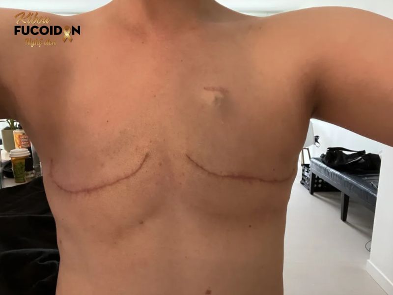 Cẩm nang thông tin về phẫu thuật ung thư vú Phẫu thuật cắt bỏ vú