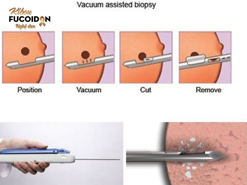 Ung thư vú dạng viêm: Dấu hiệu, cách điều trị và tiên lượng sống Sinh thiết khối u vú để tiến hành xét nghiệm