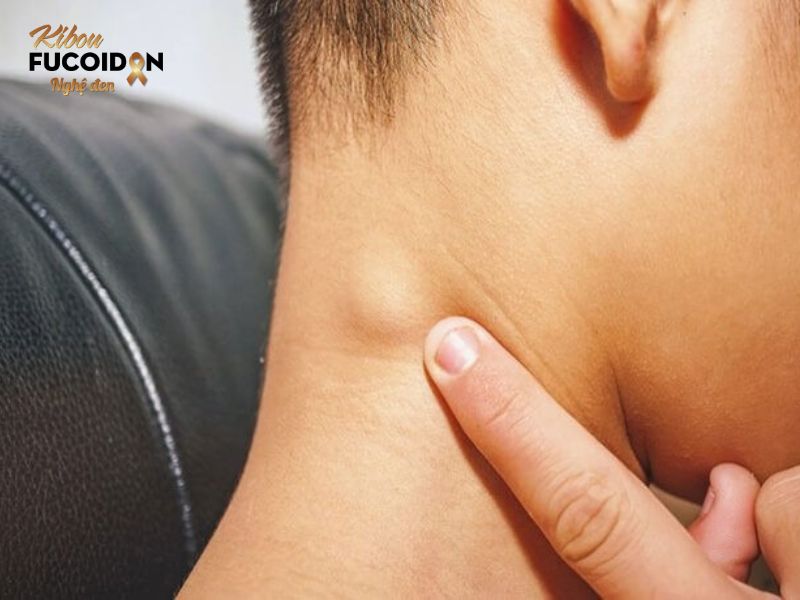 Sẽ ra sao khi các tế bào ung thư phổi di căn khắp cơ thể? Triệu chứng ung thư phổi di căn hạch thường gặp