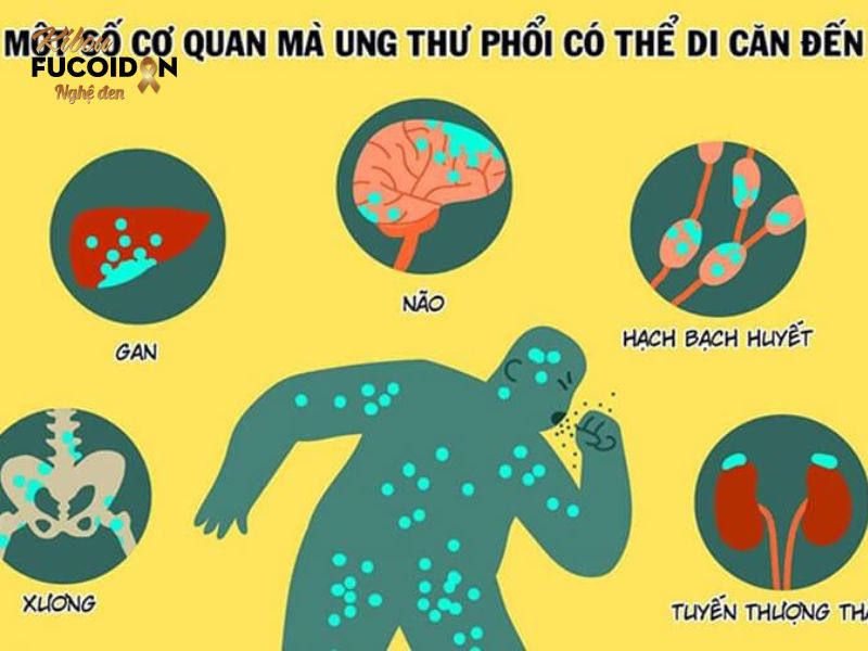 Sẽ ra sao khi các tế bào ung thư phổi di căn khắp cơ thể? Các vị trí ung thư phổi thường di căn đến