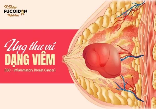 Ung thư vú dạng viêm: Dấu hiệu, cách điều trị và tiên lượng sống
