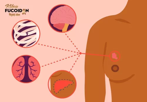 Ung thư vú di căn: Triệu chứng, chẩn đoán và cách điều trị