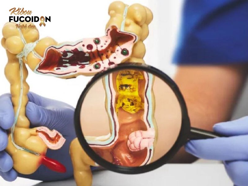 Tìm hiểu chi tiết xét nghiệm máu phát hiện ung thư đại tràng Tất cả mọi người đều nên thực hiện tầm soát ung thư đại tràng