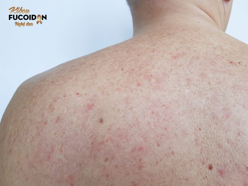 Điều trị đích ung thư phổi - 6 điều cần biết Việc điều trị miễn dịch có thể gây ra các vấn đề về da như nổi mụn