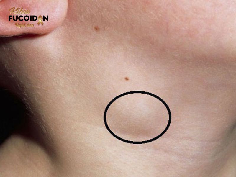 Ung thư phổi di căn hạch và tất cả thông tin cần biết Sưng hạch là dấu hiệu điển hình của các trường hợp ung thư phổi di căn hạch