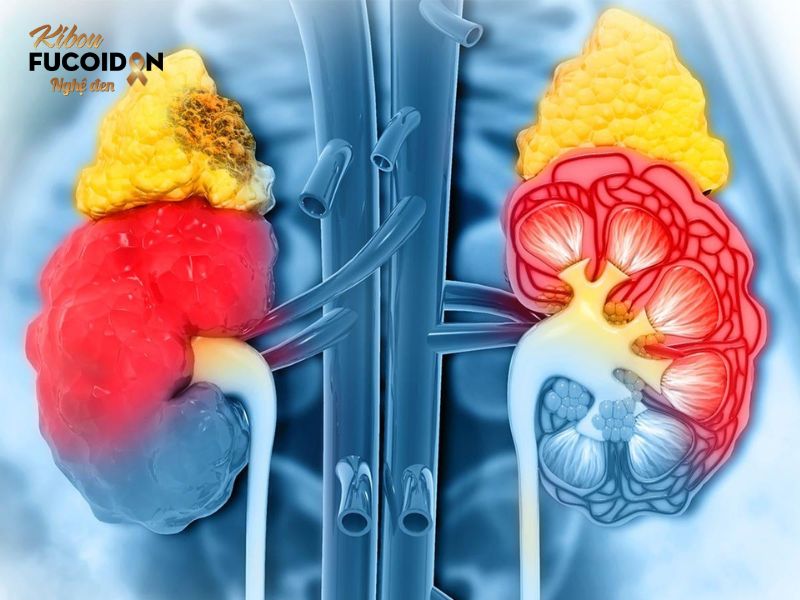 Trọn bộ kiến thức về Ung thư phổi di căn tuyến thượng thận Thời gian sống của bệnh nhân ung thư phổi di căn tuyến thượng thận phụ thuộc nhiều yếu tố