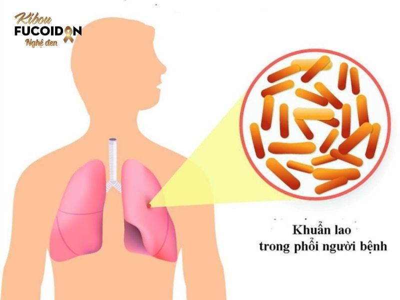 Hướng dẫn phân biệt lao phổi và ung thư phổi chính xác nhất! Nguyên nhân chính gây bệnh lao phổi là do vi khuẩn lao Mycobacterium Tuberculosis gây ra