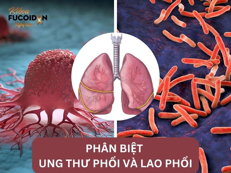 Hướng dẫn phân biệt lao phổi và ung thư phổi chính xác nhất! Phân biệt Ung thư phổi và Lao phổi