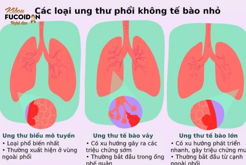 Từ A đến Z về Ung thư phổi không tế bào nhỏ Phân loại ung thư phổi không tế bào nhỏ