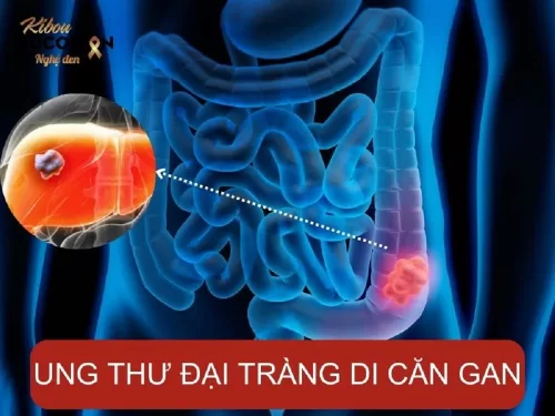 Những điều cần biết về Ung thư đại tràng di căn gan