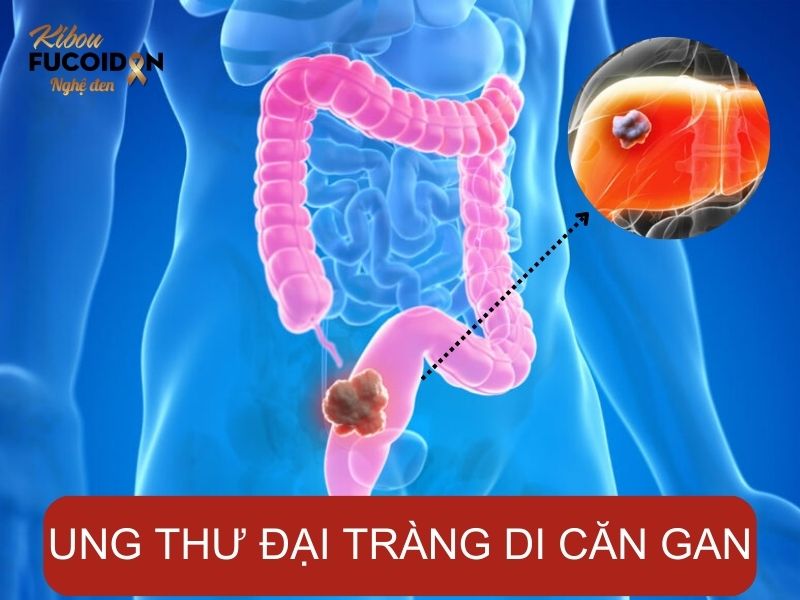 Gan là “lựa chọn số 1” của tế bào ung thư đại tràng khi di căn