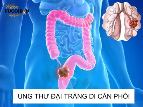 Ung thư đại tràng di căn phổi: Dấu hiệu, chẩn đoán, cách điều trị