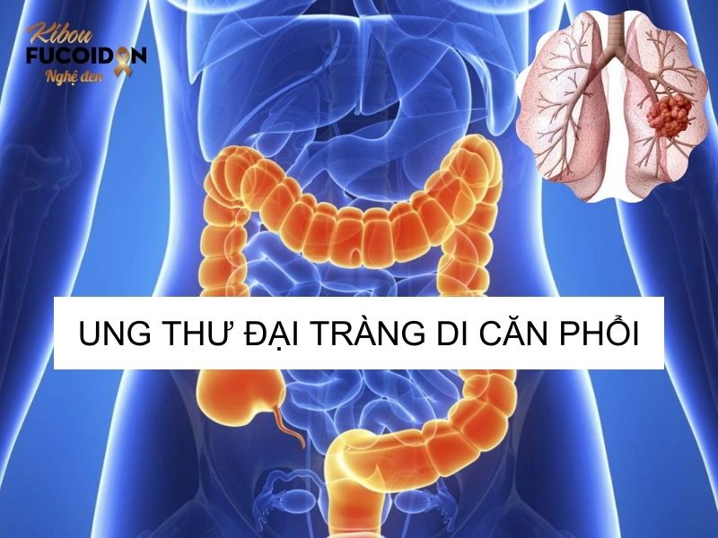Ung thư đại tràng di căn phổi: Dấu hiệu, chẩn đoán, cách điều trị Ung thư đại tràng di căn phổi là giai đoạn muộn của bệnh