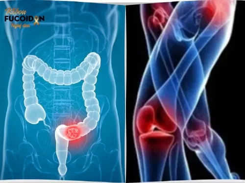Từ A đến Z về Ung thư đại tràng di căn xương