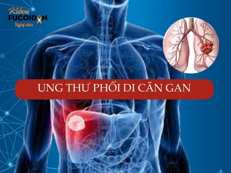 Ung thư phổi di căn gan: Dấu hiệu, tiên lượng và cách điều trị Di căn gan thường xảy ra ở ung thư phổi giai đoạn cuối