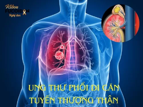 Trọn bộ kiến thức về Ung thư phổi di căn tuyến thượng thận