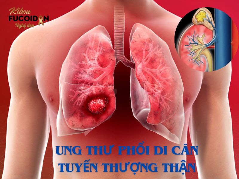 Trọn bộ kiến thức về Ung thư phổi di căn tuyến thượng thận Ung thư phổi di căn tuyến thượng thận