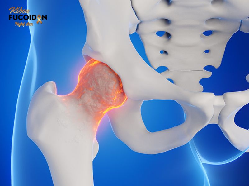 K phổi di căn xương là hiện tượng mà các tế bào ung thư phổi bắt đầu lan sang các cơ quan khác ngoài phổi K phổi di căn xương là hiện tượng mà các tế bào ung thư phổi bắt đầu lan sang các cơ quan khác ngoài phổi