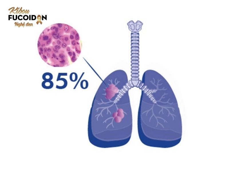 Từ A đến Z về Ung thư phổi không tế bào nhỏ Ung thư phổi không tế bào nhỏ chiếm tới 85% các trường hợp mắc ung thư phổi