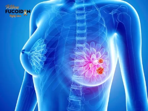 Ung thư vú bộ ba âm tính: Nguyên nhân và cách điều trị