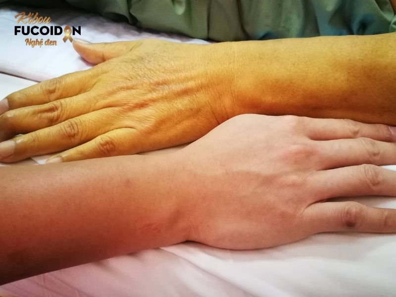 Người bệnh thường bị vàng da do sự ứ đọng dịch mật