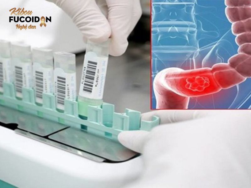Tìm hiểu chi tiết xét nghiệm máu phát hiện ung thư đại tràng Xét nghiệm tìm máu ẩn trong phân thường áp dụng để tầm soát ung thư đại tràng