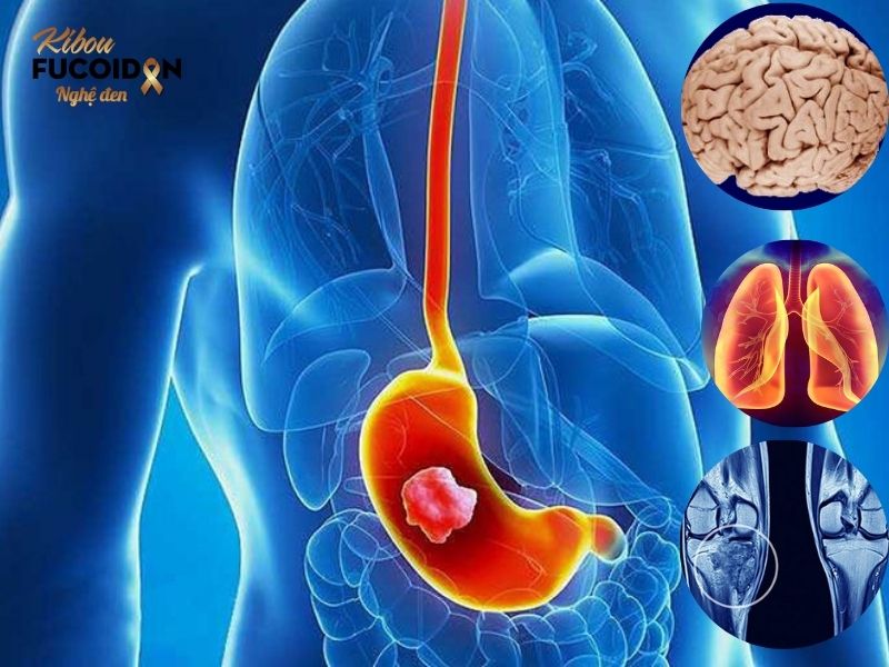 Dấu hiệu, chẩn đoán và cách điều trị Ung thư dạ dày di căn Ung thư dạ dày có thể di căn tới nhiều cơ quan trong cơ thể như não, phổi, gan, xương,...