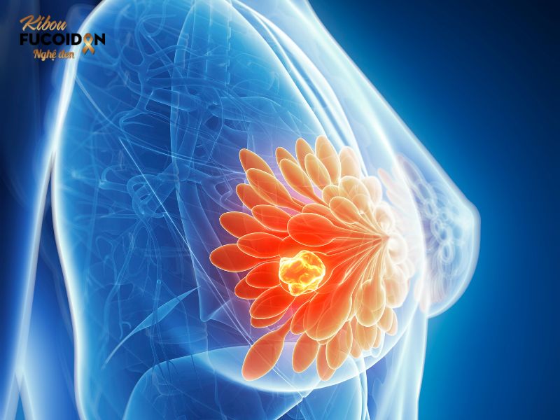 Liệu pháp miễn dịch ung thư cũng được chỉ định cho bệnh nhân ung thư vú di căn Liệu pháp miễn dịch ung thư cũng được chỉ định cho bệnh nhân ung thư vú di căn