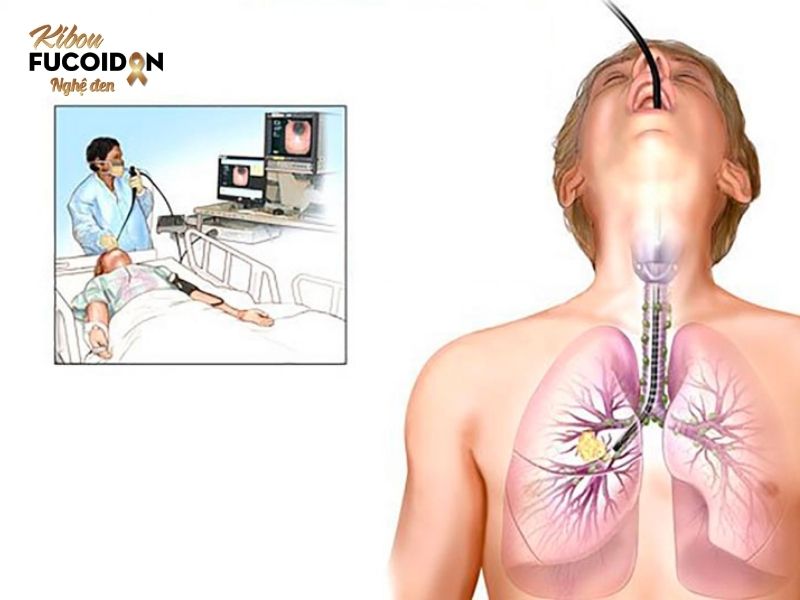 Sự nguy hiểm của ung thư dạ dày di căn phổi Nội soi phế quản tìm khối u