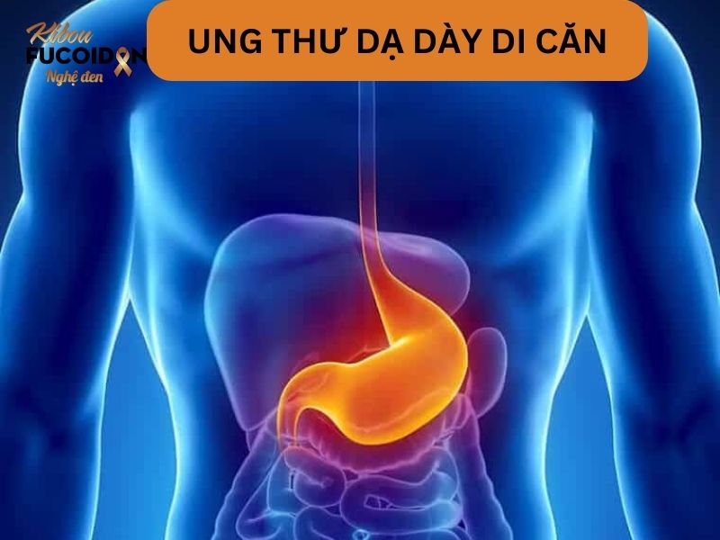 Dấu hiệu, chẩn đoán và cách điều trị Ung thư dạ dày di căn Sẽ ra sao nếu ung thư dạ dày di căn?