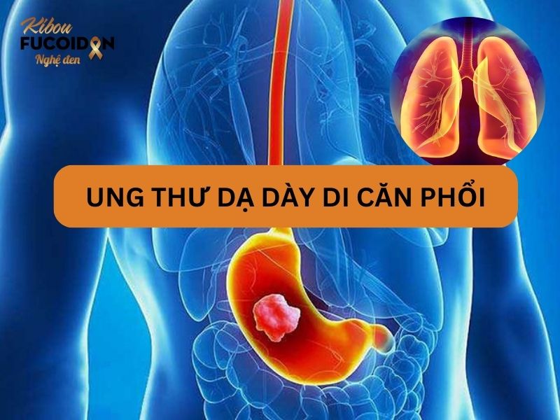 Sự nguy hiểm của ung thư dạ dày di căn phổi Ung thư dạ dày di căn phổi chiếm tới 15% các trường hợp được ung thư dạ dày
