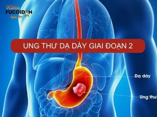 5 điều quan trọng cần biết về Ung thư dạ dày giai đoạn 2