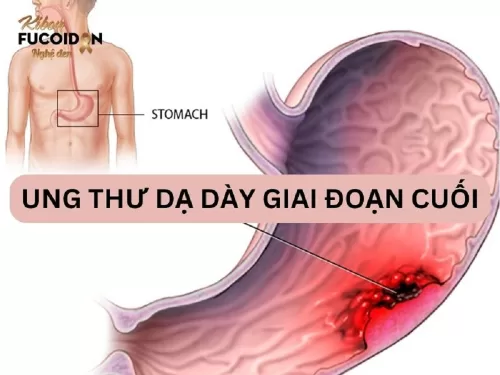 Cách điều trị và chăm sóc ung thư dạ dày giai đoạn cuối