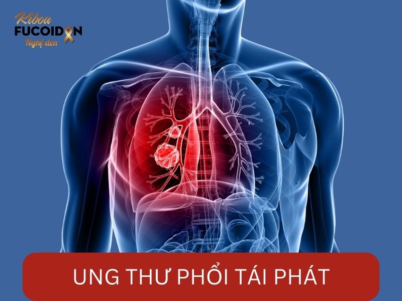 Ung thư phổi tái phát và những điều cần biết! Ung thư phổi tái phát là gì?