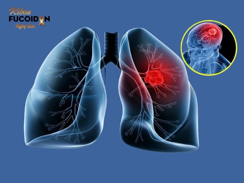 Ung thư phổi tái phát và những điều cần biết! Ung thư phổi có thể tái phát tại chỗ hay các vị trí ở xa như não, gan,...