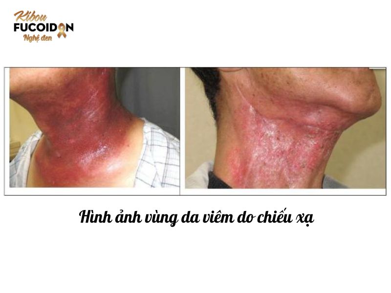Tổn thương vùng da chiếu xạ