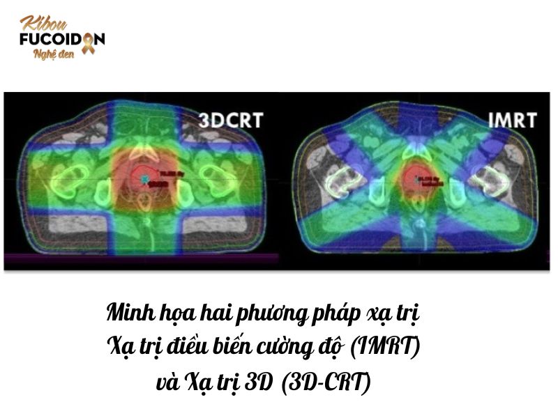 Có hai hình thức xạ trị chính được sử dụng trong điều trị ung thư dạ dày