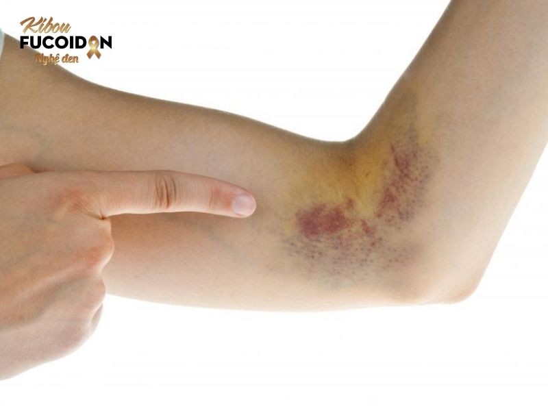 Cảnh giác với những vết bầm tím không phải do va đập