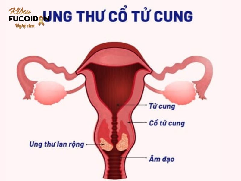 Bạn có biết: 7 loại ung thư có khả năng chữa khỏi? Ung thư cổ tử cung