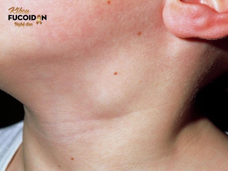 Bạn có biết: 7 loại ung thư có khả năng chữa khỏi? Ung thư hạch