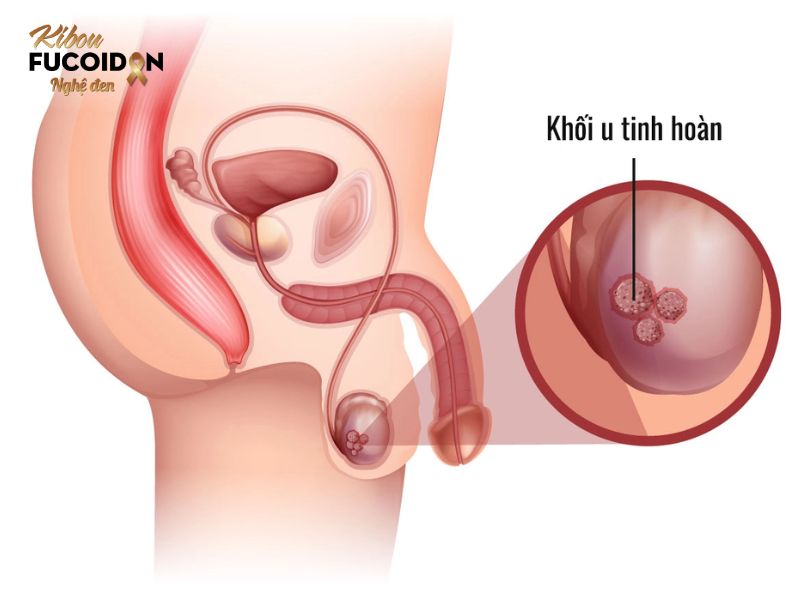 Bạn có biết: 7 loại ung thư có khả năng chữa khỏi? Ung thư tinh hoàn